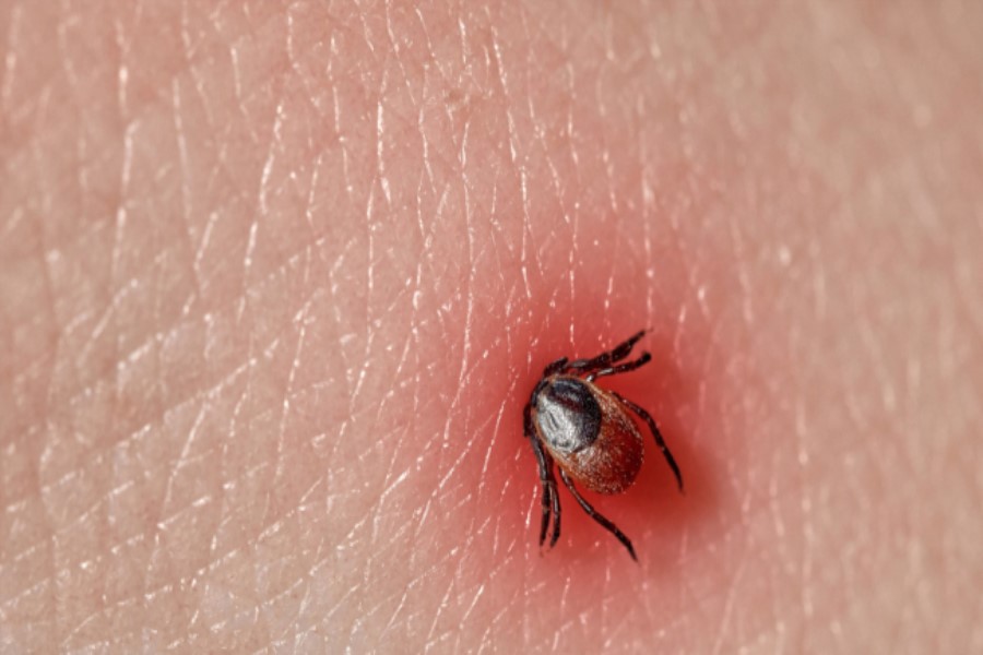 Gənə dişləməsi tez diaqnoz tələb edən borrelioz inkişaf etdirə bilər