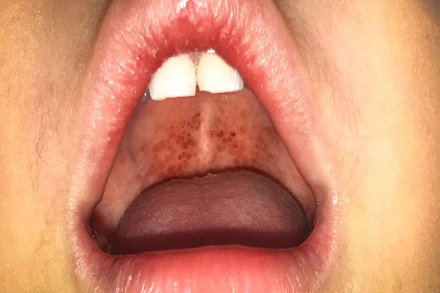 İngiltərədə "Strep A" bakteriyası 94 nəfərin ölümünə səbəb olub - ÖZƏL