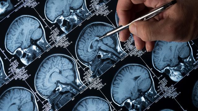 Probiotiklər yaddaşı qorumağa kömək edə bilər – yeni araşdırma